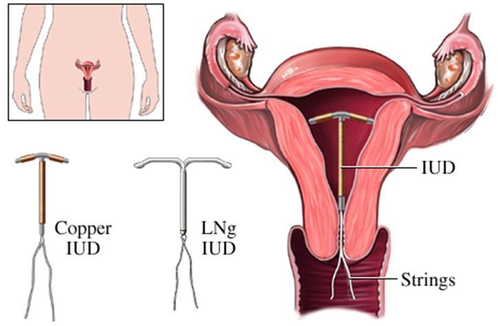 Your Guide To Non Hormonal Birth Control Part 1 The Copper Iud Kendra Perry Nutrition 6868